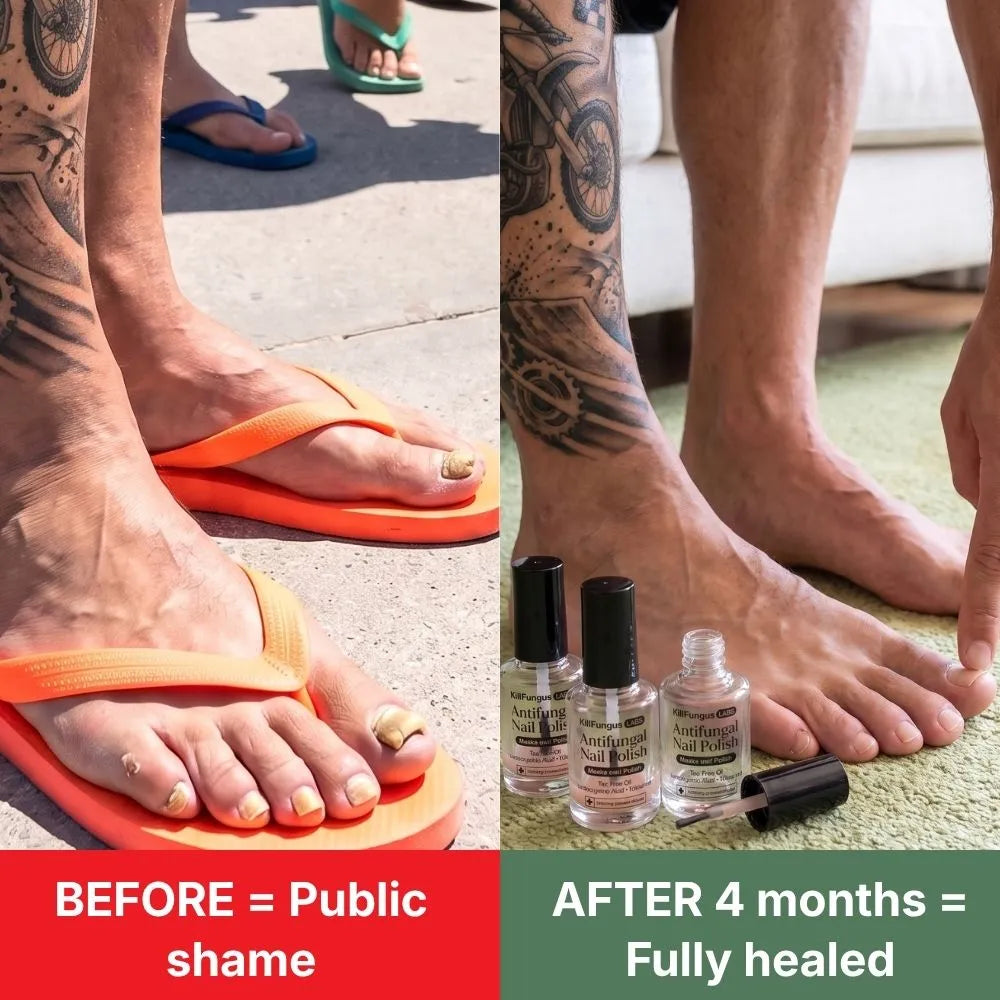 Antifungal Nail Polish