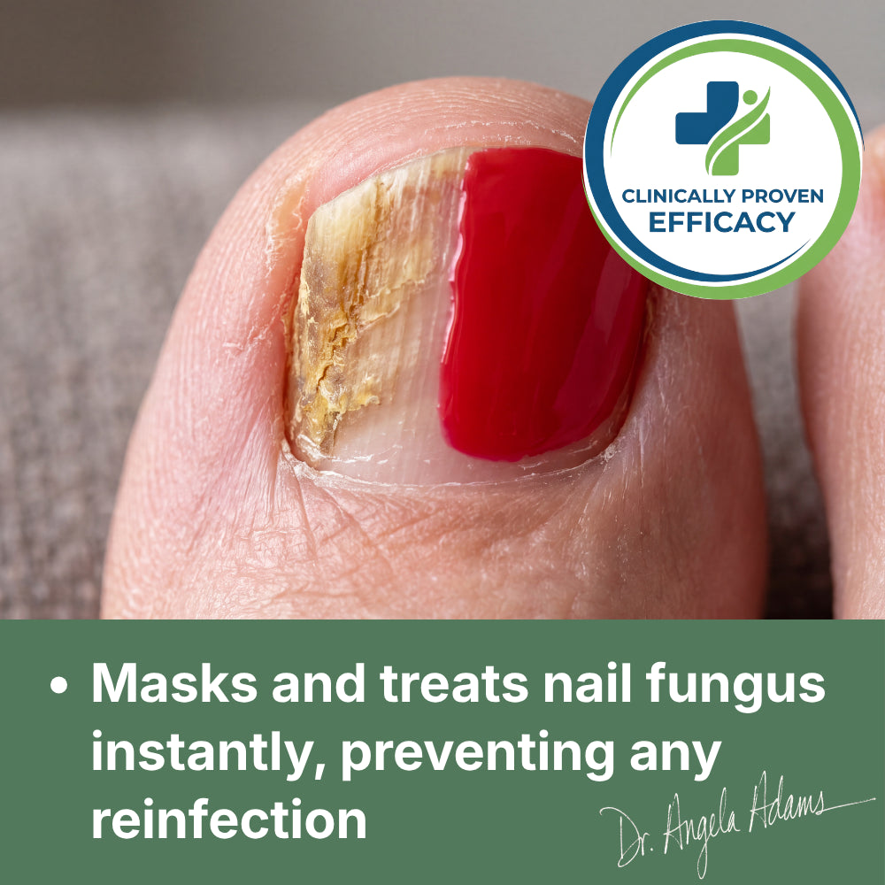 Antifungal Nail Polish